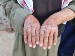 وزارة الصحة تطلق إحصاءً للمصابين بالأمراض النادرة